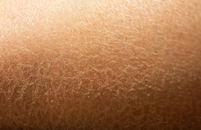 dry skin because of hard water